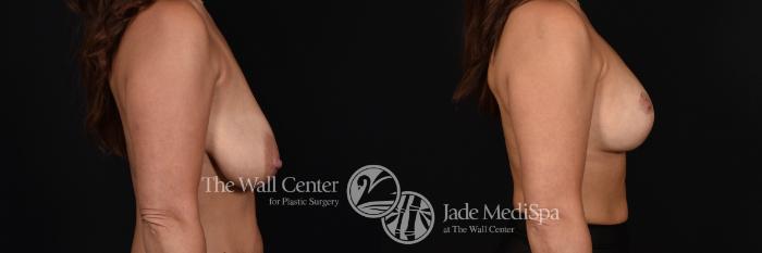 Breast Aug with Lift Right Side Photo, Shreveport, Louisiana, The Wall Center for Plastic Surgery, Case 830