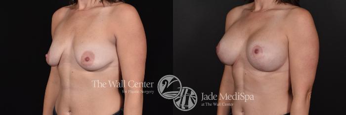 Breast Aug with Lift Left Oblique Photo, Shreveport, Louisiana, The Wall Center for Plastic Surgery, Case 831