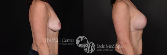 Breast Aug with Lift Right Side Photo, Shreveport, Louisiana, The Wall Center for Plastic Surgery, Case 831