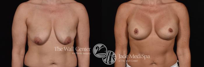 Breast Aug with Lift Front Photo, Shreveport, Louisiana, The Wall Center for Plastic Surgery, Case 834