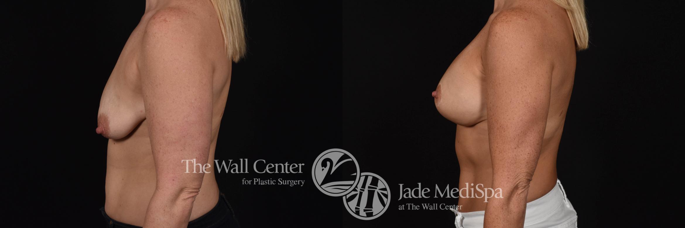 Breast Aug with Lift Left Side Photo, Shreveport, Louisiana, The Wall Center for Plastic Surgery, Case 834