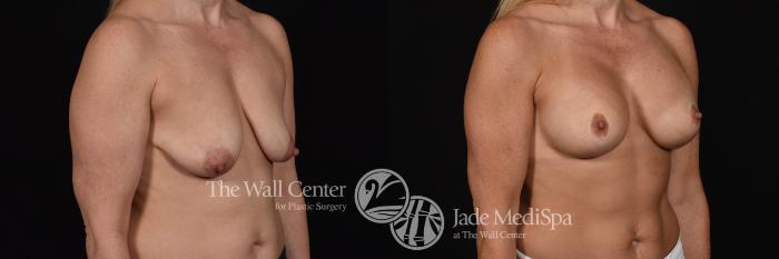Breast Aug with Lift Right Oblique Photo, Shreveport, Louisiana, The Wall Center for Plastic Surgery, Case 834
