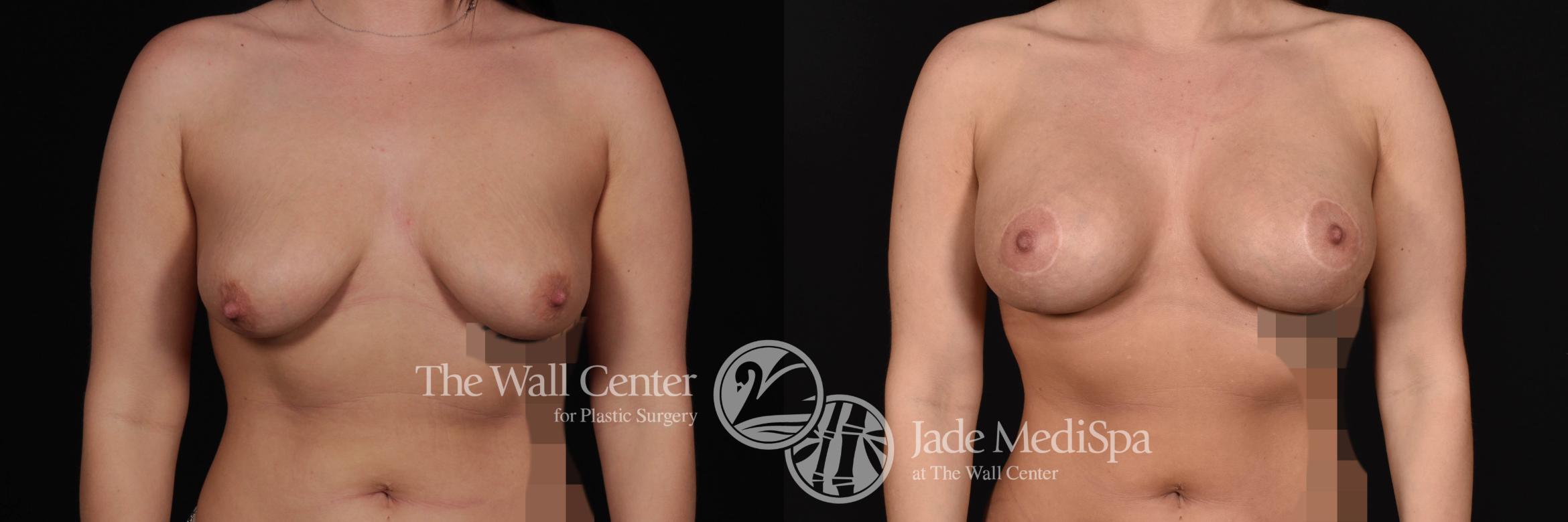 Breast Aug with Lift Front Photo, Shreveport, Louisiana, The Wall Center for Plastic Surgery, Case 835