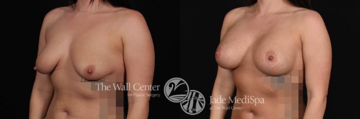 Breast Aug with Lift Left Oblique Photo, Shreveport, Louisiana, The Wall Center for Plastic Surgery, Case 835
