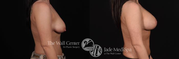 Breast Aug with Lift Right Side Photo, Shreveport, Louisiana, The Wall Center for Plastic Surgery, Case 835