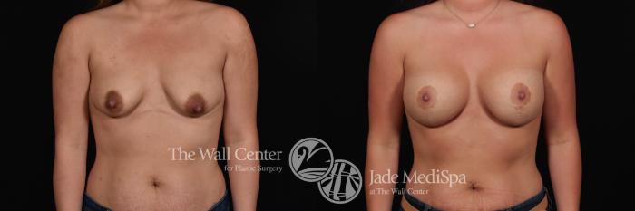 Breast Aug with Lift Front Photo, Shreveport, Louisiana, The Wall Center for Plastic Surgery, Case 838