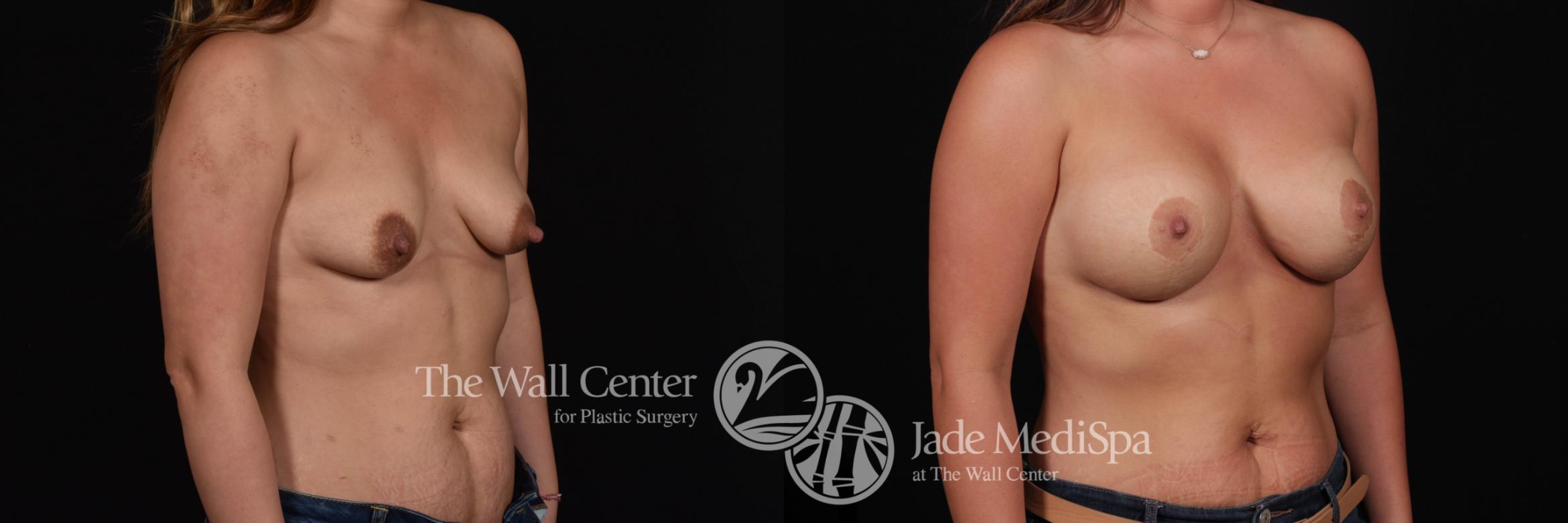 Breast Aug with Lift Right Oblique Photo, Shreveport, Louisiana, The Wall Center for Plastic Surgery, Case 838