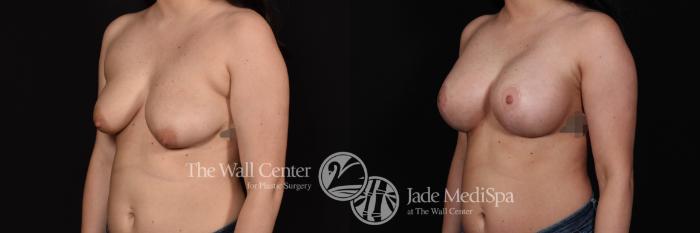 Breast Aug with Lift Front Photo, Shreveport, Louisiana, The Wall Center for Plastic Surgery, Case 843
