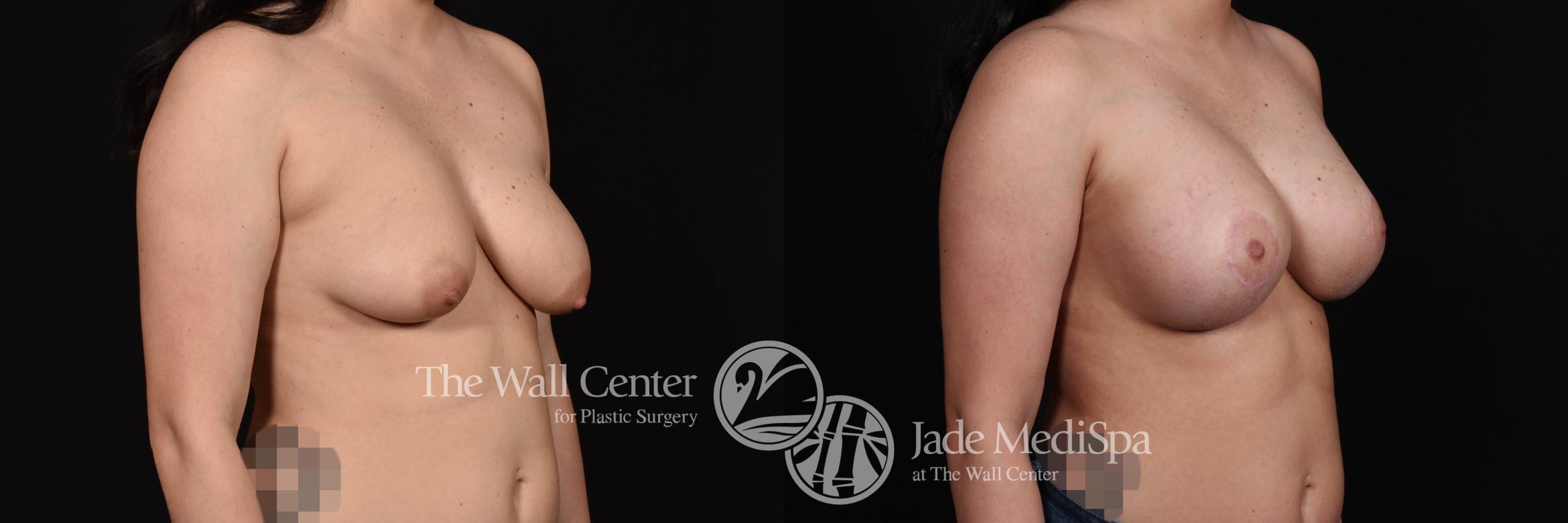 Breast Aug with Lift Right Oblique Photo, Shreveport, Louisiana, The Wall Center for Plastic Surgery, Case 843