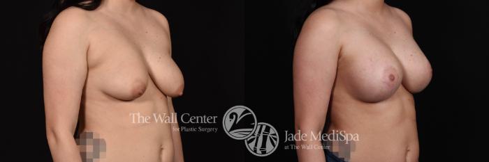 Breast Aug with Lift Right Oblique Photo, Shreveport, Louisiana, The Wall Center for Plastic Surgery, Case 843