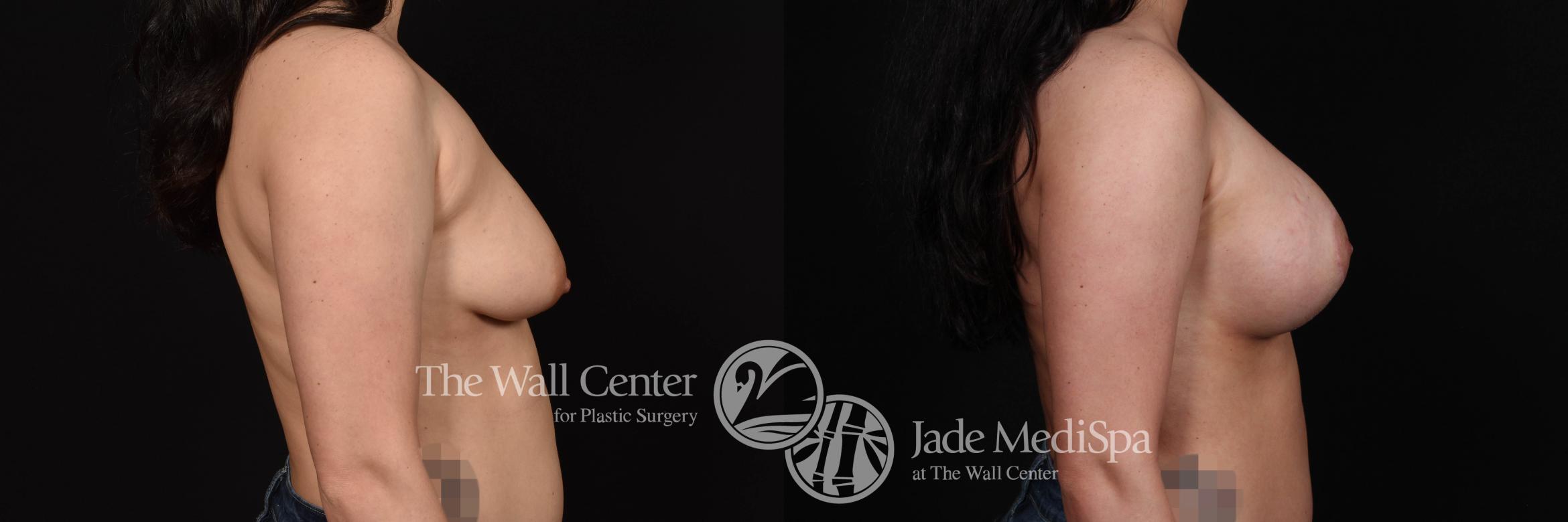 Breast Aug with Lift Right Side Photo, Shreveport, Louisiana, The Wall Center for Plastic Surgery, Case 843