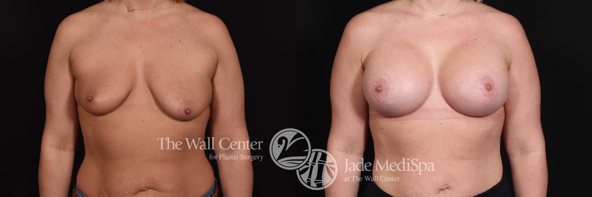 Breast Aug with Lift Front Photo, Shreveport, Louisiana, The Wall Center for Plastic Surgery, Case 848