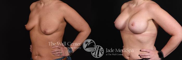 Breast Aug with Lift Left Oblique Photo, Shreveport, Louisiana, The Wall Center for Plastic Surgery, Case 848