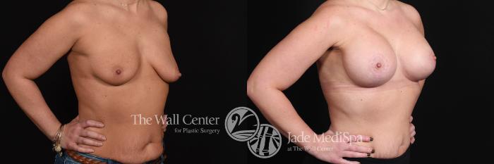 Breast Aug with Lift Right Oblique Photo, Shreveport, Louisiana, The Wall Center for Plastic Surgery, Case 848