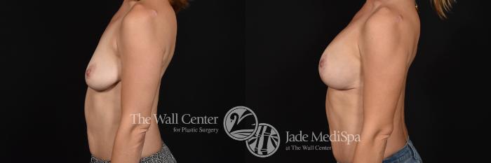 Breast Aug with Lift Left Side Photo, Shreveport, Louisiana, The Wall Center for Plastic Surgery, Case 863