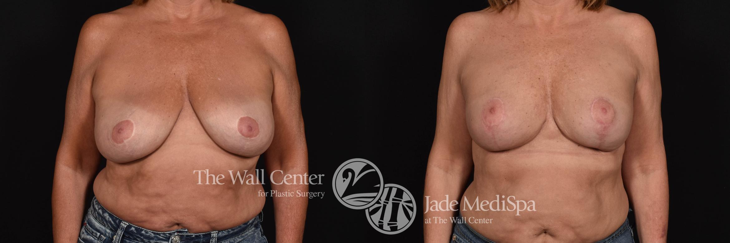Breast Aug with Lift & SAFELipo Front Photo, Shreveport, Louisiana, The Wall Center for Plastic Surgery, Case 873