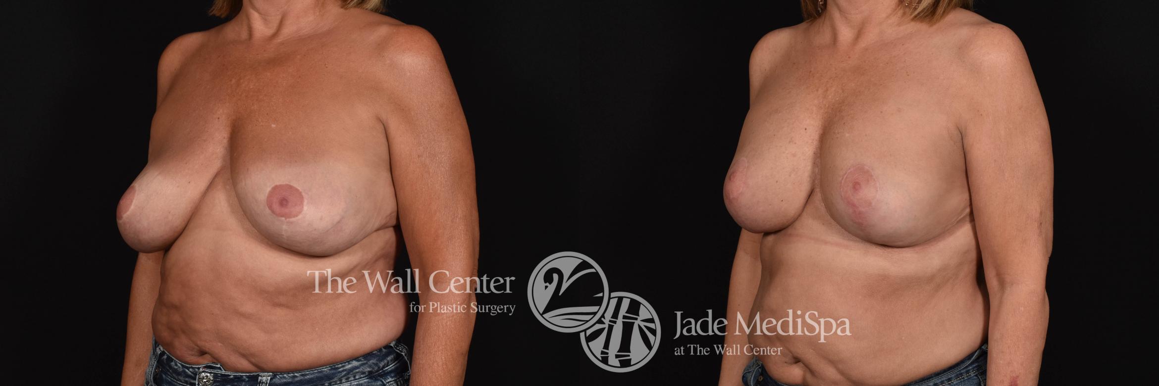 Breast Aug with Lift & SAFELipo Left Oblique Photo, Shreveport, Louisiana, The Wall Center for Plastic Surgery, Case 873