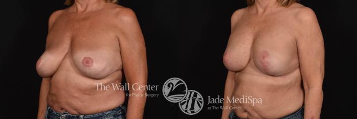 Breast Aug with Lift & SAFELipo Left Oblique Photo, Shreveport, Louisiana, The Wall Center for Plastic Surgery, Case 873