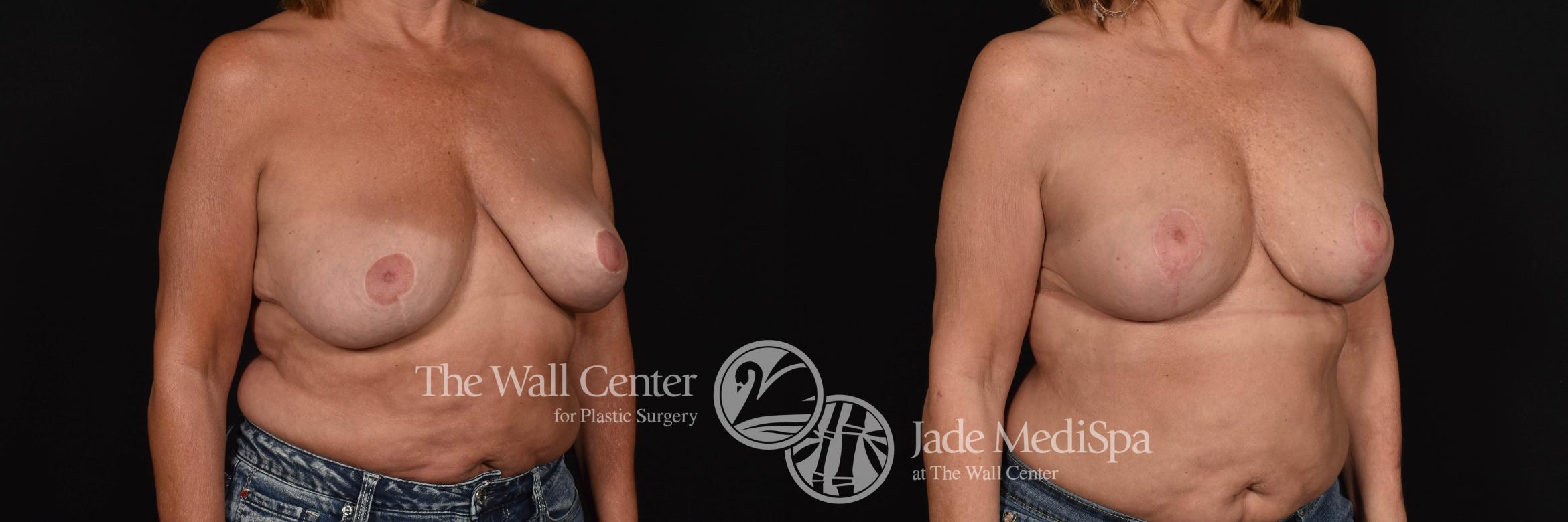 Breast Aug with Lift & SAFELipo Right Oblique Photo, Shreveport, Louisiana, The Wall Center for Plastic Surgery, Case 873