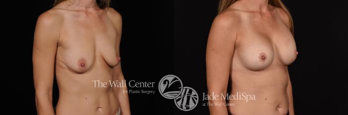 Breast Aug with Lift Right Oblique Photo, Shreveport, Louisiana, The Wall Center for Plastic Surgery, Case 881
