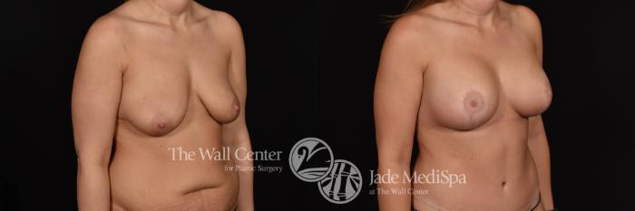 Breast Aug with Lift Right Oblique Photo, Shreveport, Louisiana, The Wall Center for Plastic Surgery, Case 882