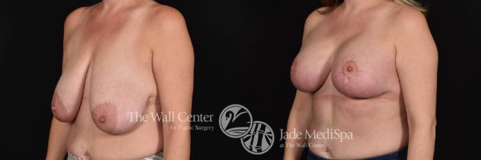 Breast Aug with Lift Left Oblique Photo, Shreveport, Louisiana, The Wall Center for Plastic Surgery, Case 891