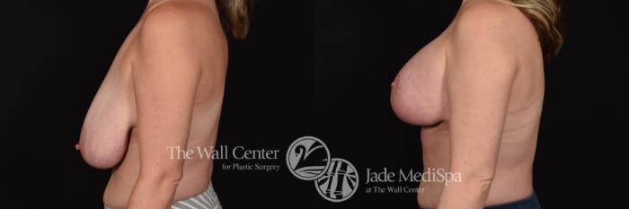 Breast Aug with Lift Left Side Photo, Shreveport, Louisiana, The Wall Center for Plastic Surgery, Case 891