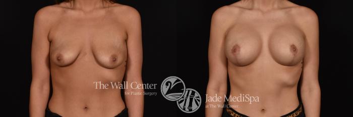 Breast Aug with Lift & SAFELipo Front Photo, Shreveport, Louisiana, The Wall Center for Plastic Surgery, Case 896