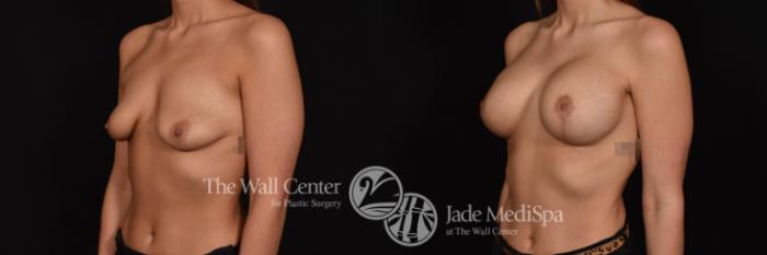 Breast Aug with Lift & SAFELipo Left Oblique Photo, Shreveport, Louisiana, The Wall Center for Plastic Surgery, Case 896