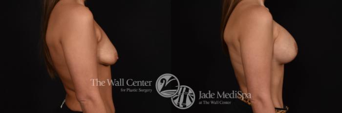 Breast Aug with Lift & SAFELipo Right Side Photo, Shreveport, Louisiana, The Wall Center for Plastic Surgery, Case 896