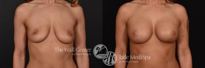 Breast Aug with Lift Front Photo, Shreveport, Louisiana, The Wall Center for Plastic Surgery, Case 923