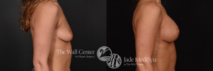 Breast Aug with Lift Right Side Photo, Shreveport, Louisiana, The Wall Center for Plastic Surgery, Case 923