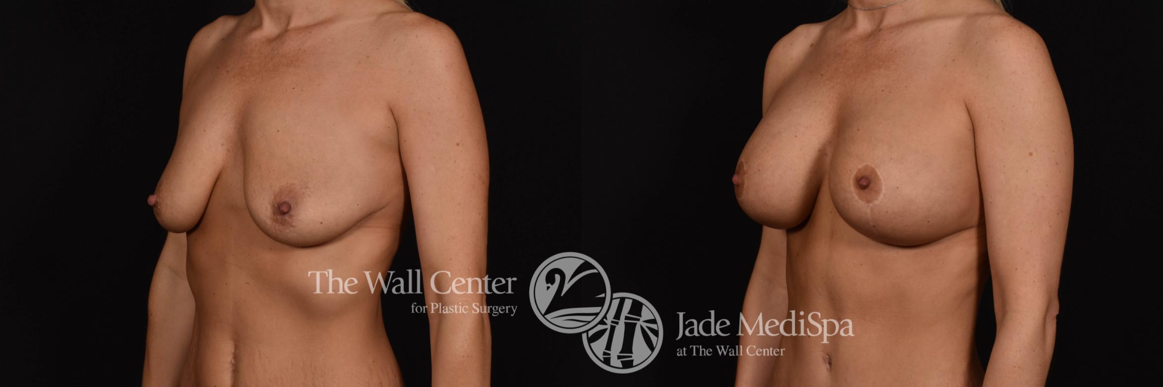 Breast Aug with Lift Left Oblique Photo, Shreveport, Louisiana, The Wall Center for Plastic Surgery, Case 926