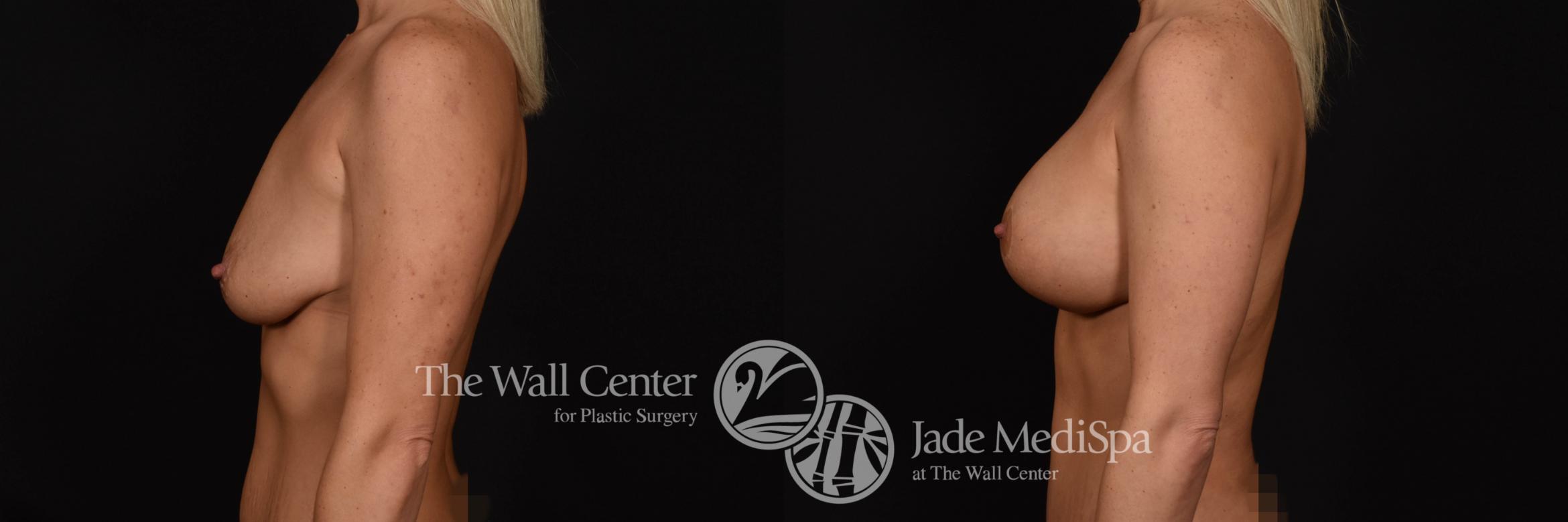 Breast Aug with Lift, Left Side Photo, Shreveport, Louisiana, The Wall Center for Plastic Surgery, Case 926