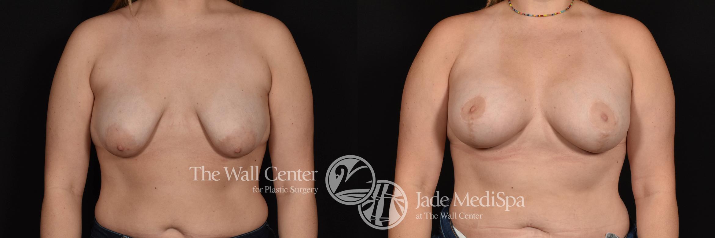 Breast Aug with Lift Front Photo, Shreveport, Louisiana, The Wall Center for Plastic Surgery, Case 933