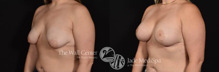 Breast Aug with Lift Left Oblique Photo, Shreveport, Louisiana, The Wall Center for Plastic Surgery, Case 933