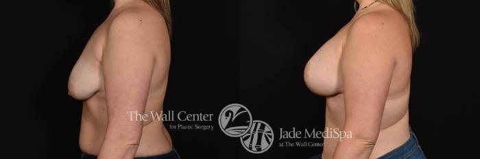 Breast Aug with Lift Left Side Photo, Shreveport, Louisiana, The Wall Center for Plastic Surgery, Case 933
