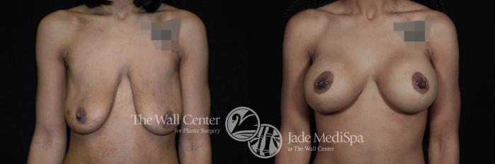 Breast Aug with Lift Front Photo, Shreveport, Louisiana, The Wall Center for Plastic Surgery, Case 934