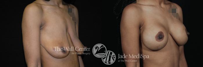Breast Aug with Lift Right Oblique Photo, Shreveport, Louisiana, The Wall Center for Plastic Surgery, Case 934