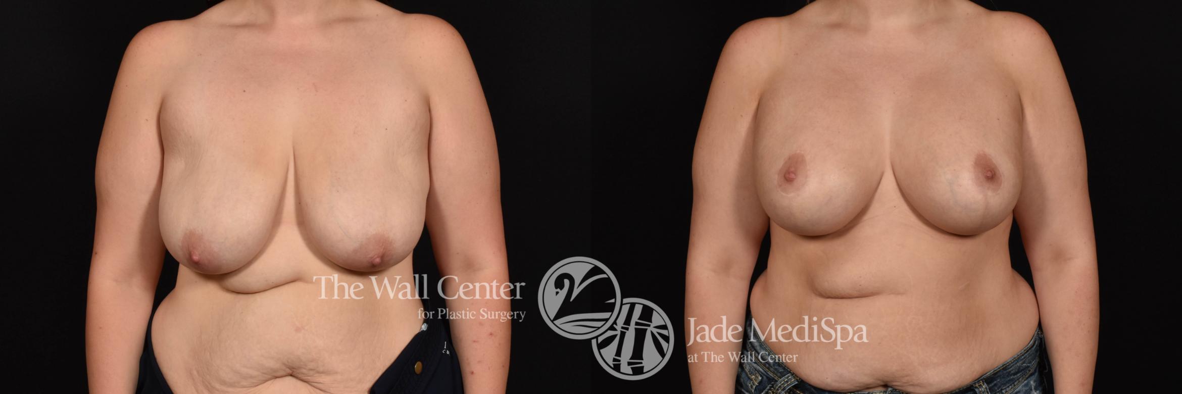 Breast Aug with Lift and SAFELipo to Axillae Front Photo, Shreveport, Louisiana, The Wall Center for Plastic Surgery, Case 938