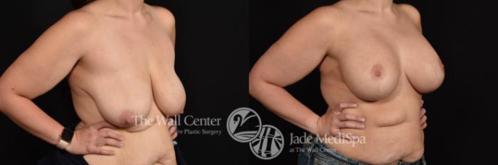 Breast Aug with Lift and SAFELipo to Axillae Lateral Shaping Photo, Shreveport, Louisiana, The Wall Center for Plastic Surgery, Case 938