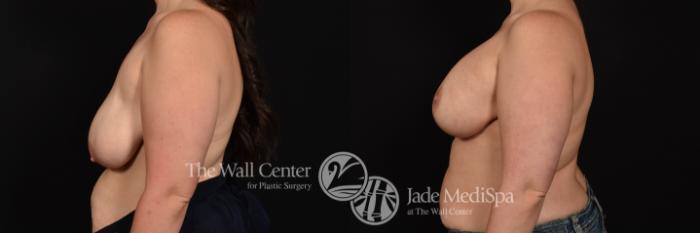 Breast Aug with Lift and SAFELipo to Axillae Left Side Photo, Shreveport, Louisiana, The Wall Center for Plastic Surgery, Case 938