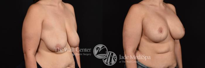 Breast Aug with Lift and SAFELipo to Axillae Right Oblique Photo, Shreveport, Louisiana, The Wall Center for Plastic Surgery, Case 938