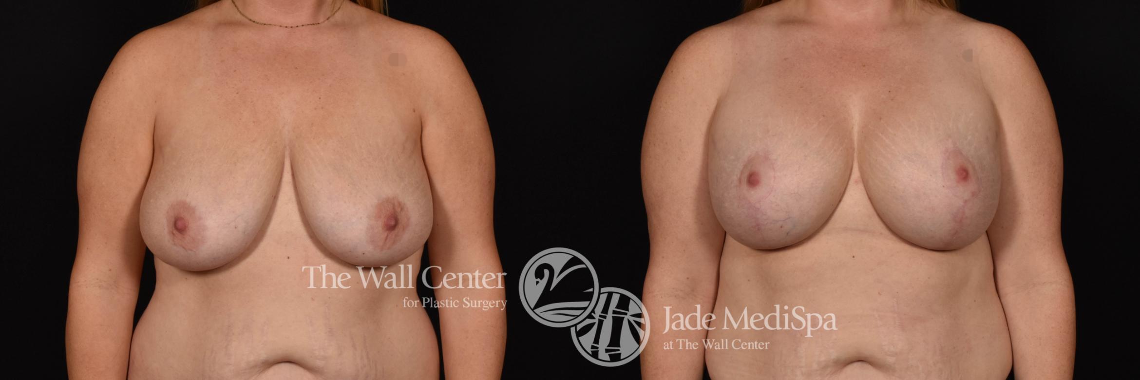 Breast Aug with Lift and SAFELipo to Axillae Front Photo, Shreveport, Louisiana, The Wall Center for Plastic Surgery, Case 941