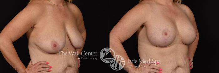 Breast Aug with Lift and SAFELipo to Axillae Lateral Shaping Photo, Shreveport, Louisiana, The Wall Center for Plastic Surgery, Case 941