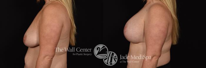 Breast Aug with Lift and SAFELipo to Axillae Left Side Photo, Shreveport, Louisiana, The Wall Center for Plastic Surgery, Case 941