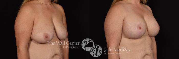 Breast Aug with Lift and SAFELipo to Axillae Right Oblique Photo, Shreveport, Louisiana, The Wall Center for Plastic Surgery, Case 941