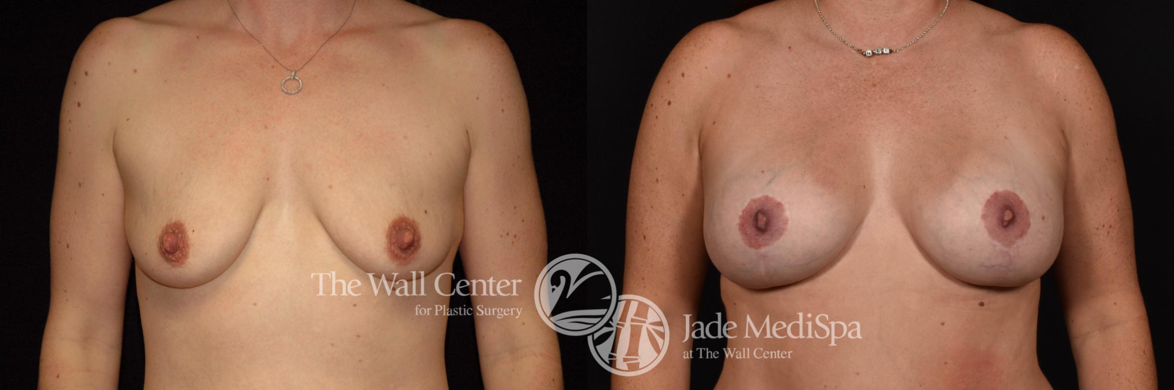 Breast Aug with Lift Front Photo, Shreveport, Louisiana, The Wall Center for Plastic Surgery, Case 944