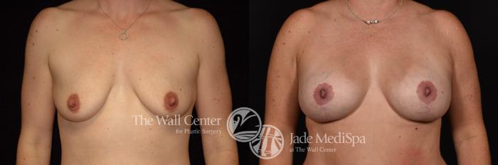 Breast Aug with Lift Front Photo, Shreveport, Louisiana, The Wall Center for Plastic Surgery, Case 944