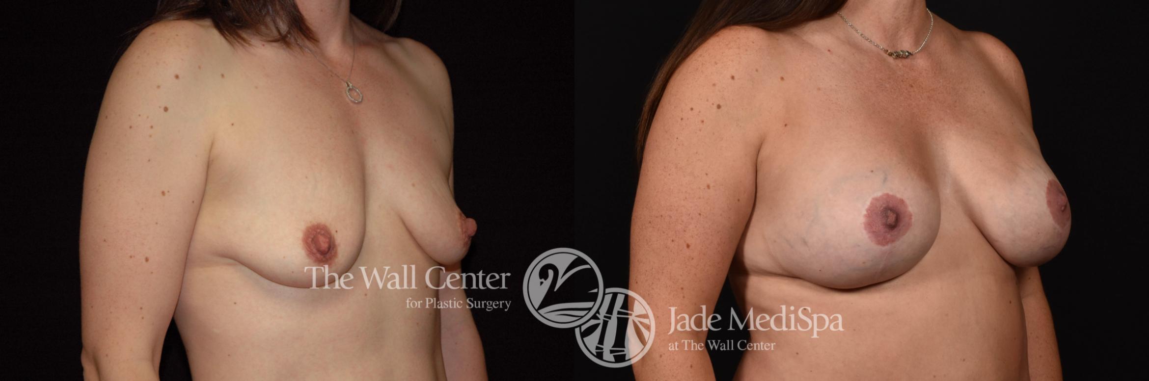 Breast Aug with Lift Right Oblique Photo, Shreveport, Louisiana, The Wall Center for Plastic Surgery, Case 944